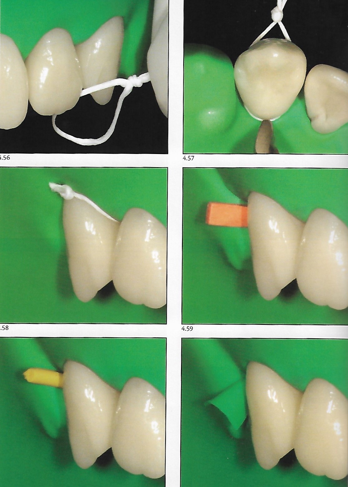 Rubber dam isolation of the anterior segment Dental Esthetics