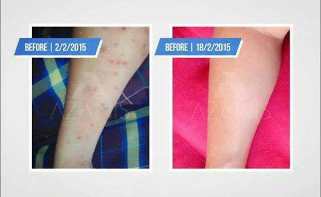 Testimoni Azanis Scar Serum - Parut Berbintik