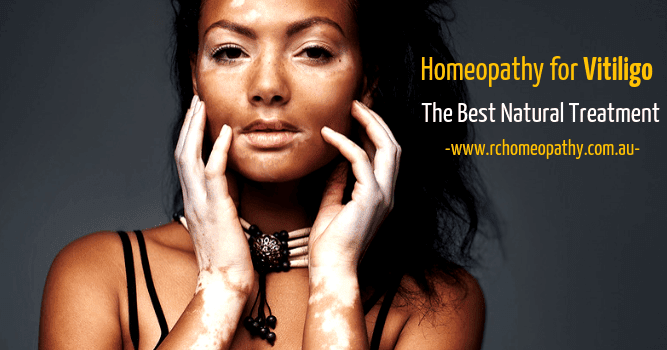 Homeopathy Treatment For Vitiligo