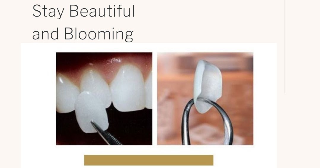 Porcelain Veneer and its Procedure