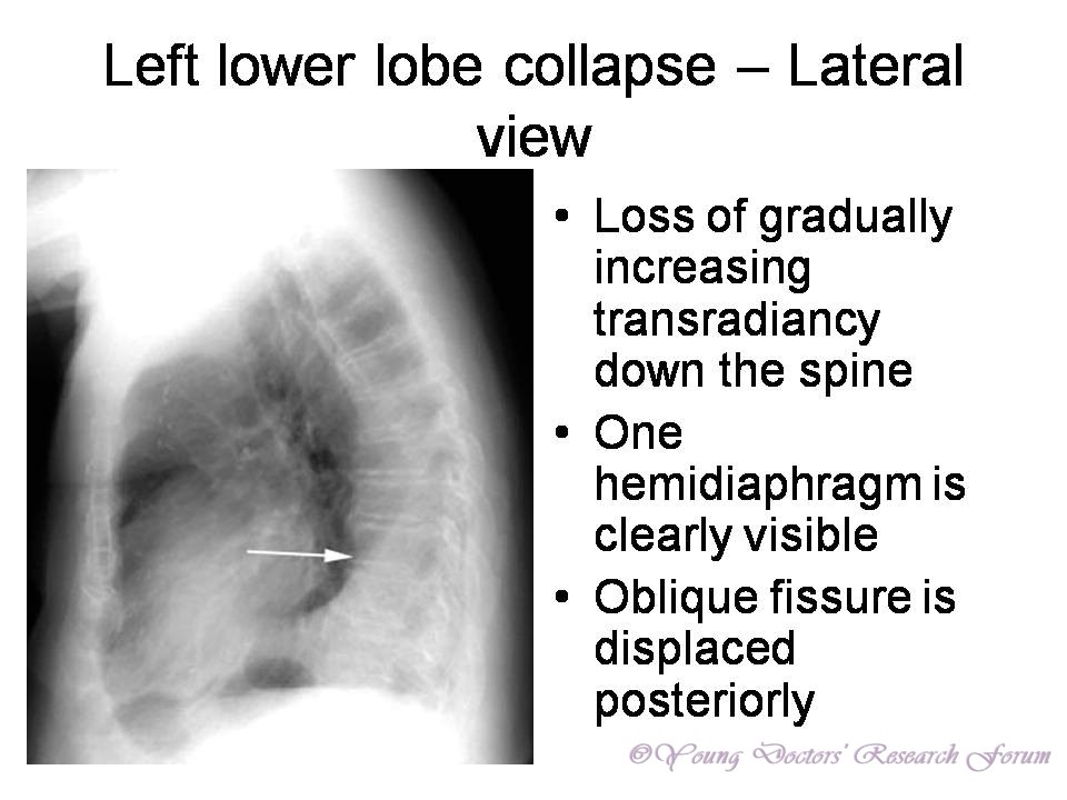 Identification of Chest Xrays of Common Lung Diseases YOUNG DOCTORS