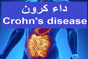 داء كرون Crohn's disease