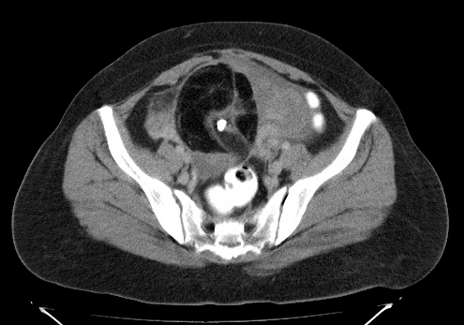 radiodiagnosis-imaging-is-amazing-interesting-cases-ovarian-dermoid-ct