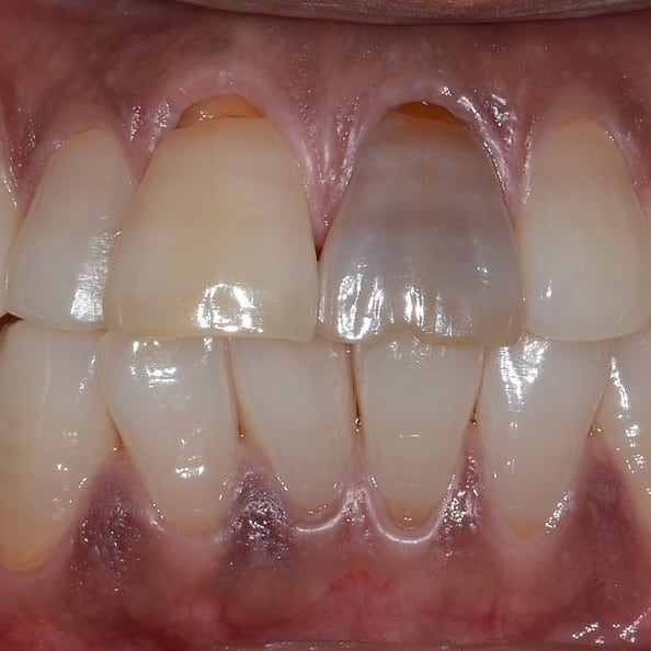 Management of a NonVital Central Incisor Tooth with Three Root Canals