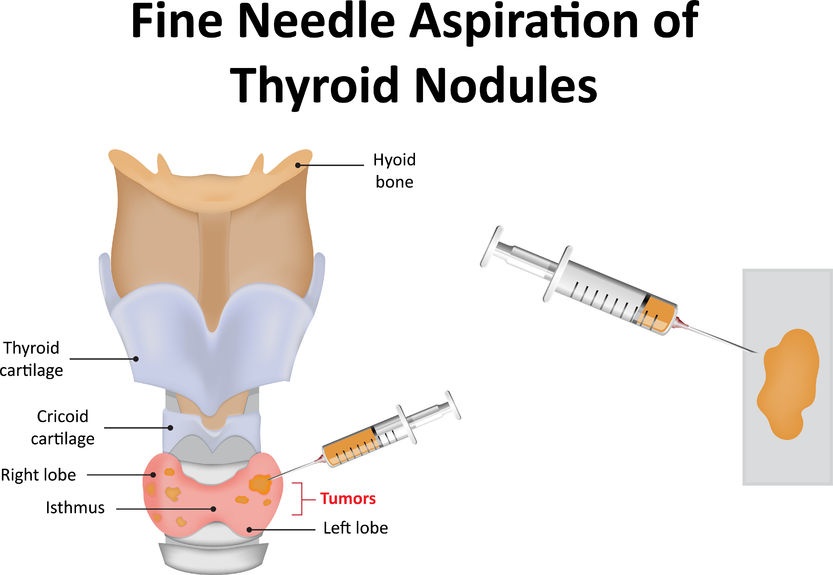 Ujian biopsy untuk bengkak tiroid. - CIKLAPUNYABELOG DOT 