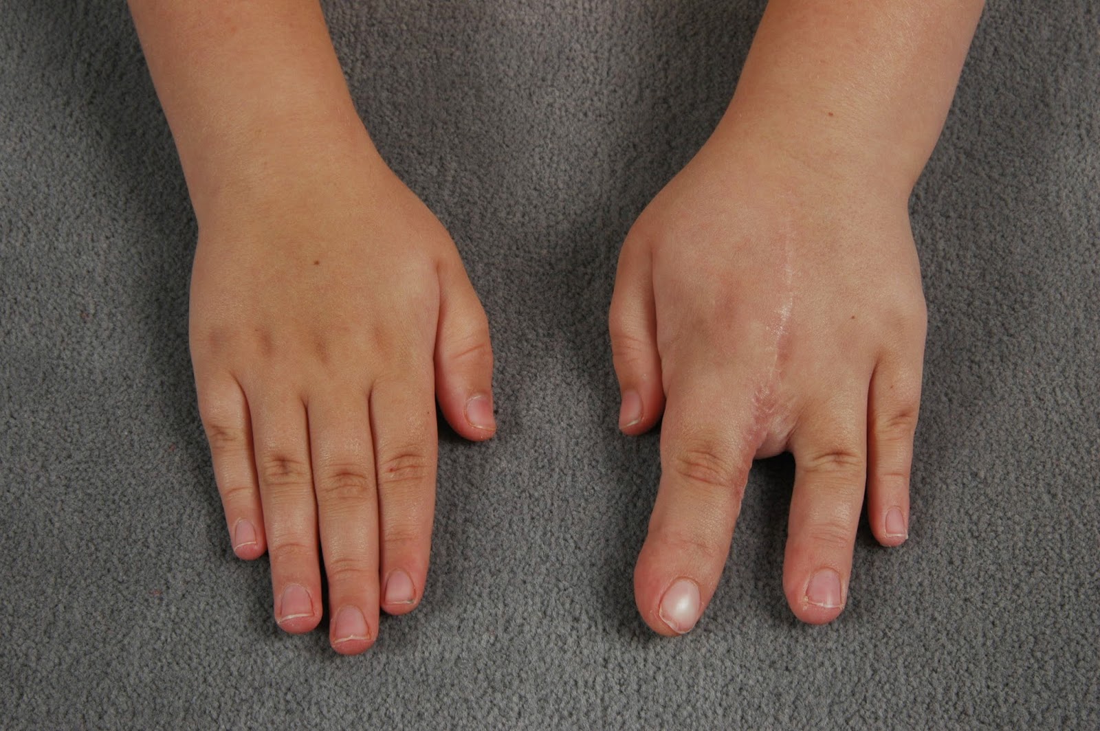 Macrodactyly Big Fingers Congenital Hand And Arm Differences Washington University In St Louis