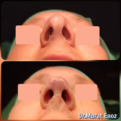 Revision Septorhinoplasty Operation For Cartilaginous Pollybeak Deformity, Inverted V Nose Deformity, Nasal Valve Collapse, Scoliotic Nose Deformity, Severe Nasal Septum Deviation