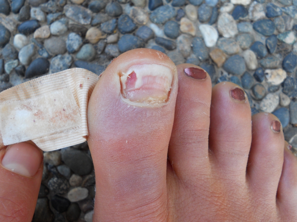 2. How to Tell if Your Toe Nail Color is a Sign of Poor Health - wide 6