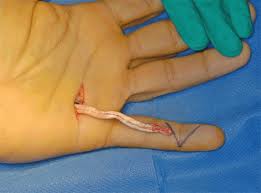hand surgery