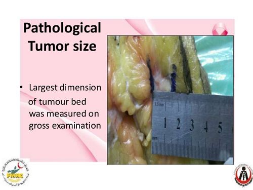 peritoneal mesothelioma peritoneal mesothelioma