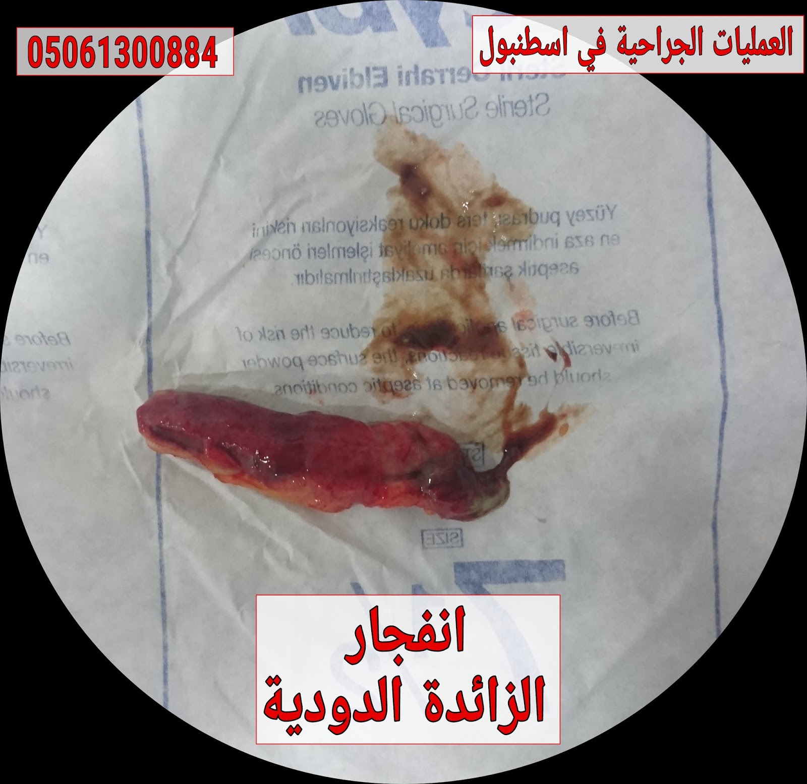 التهاب الزائدة الدودية الأسباب والأعراض والتشخيص والعلاج أنا أصدق العلم