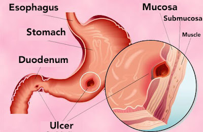 http://gastrosurgeoncochin.com/ulcer-disease/