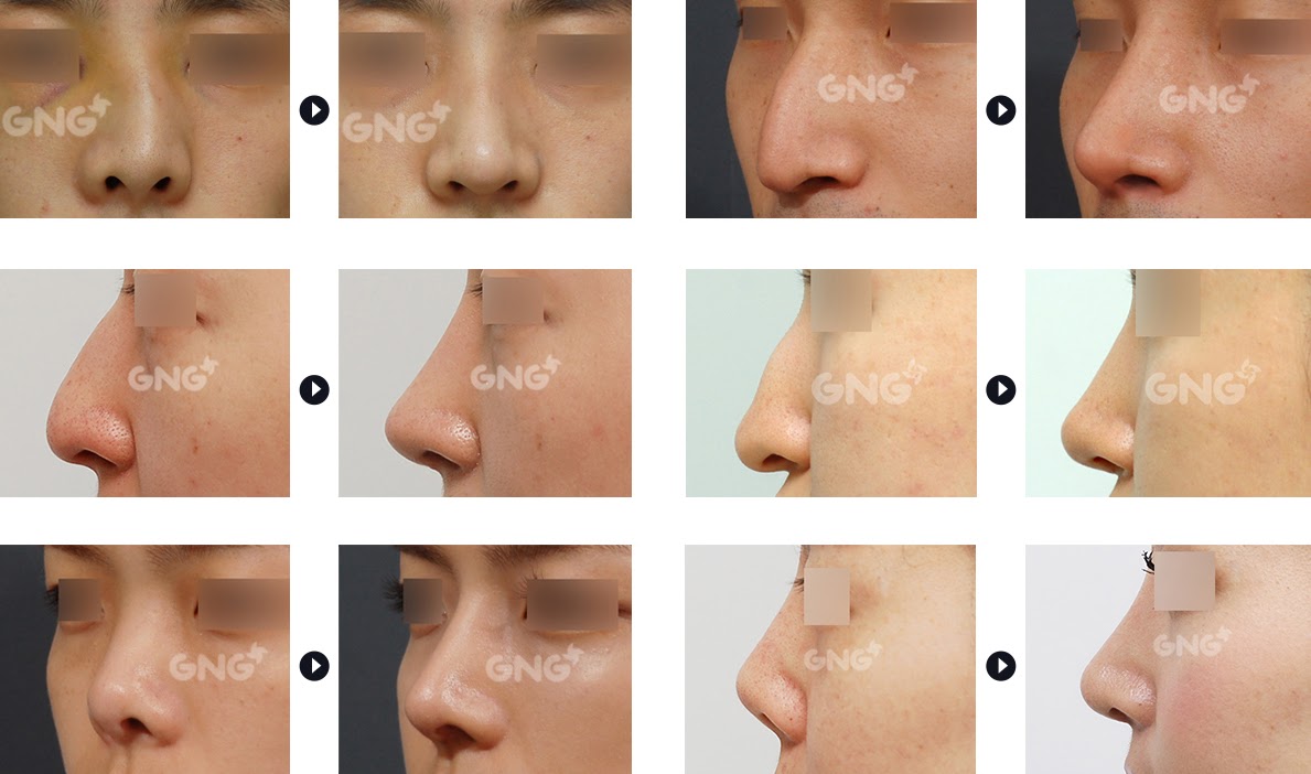 GNG Plastic Surgery Hospital Different Types of Rhinoplasty