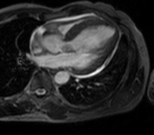 Left Ventricular Hypertrophy- Cardiac MRI - Sumer&#39;s Radiology Blog