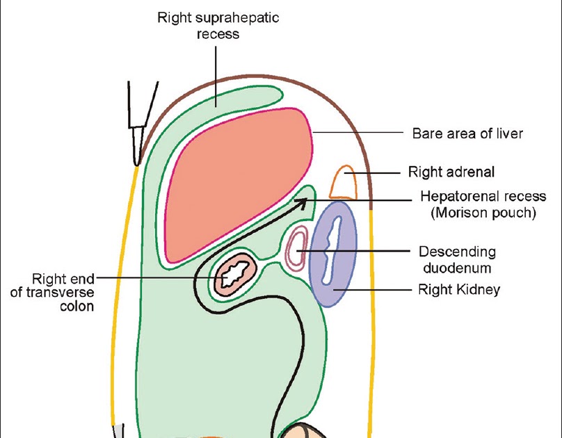 Medical Terms & Сlinical Сases Morison’s pouch
