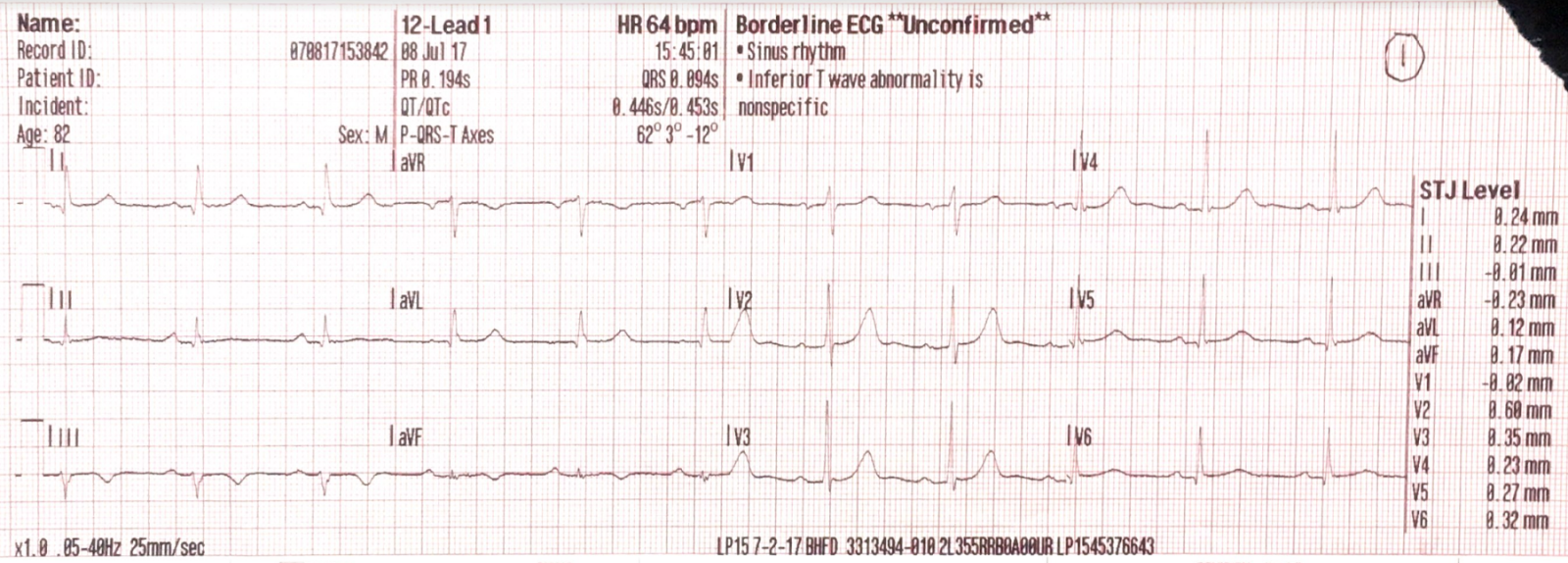 Sinus Rhythm Nonspecific T Wave Abnormality Borderline Ecg Deals