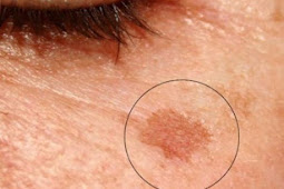 Remove Dark Spots On Your Face In Just 3 Nights