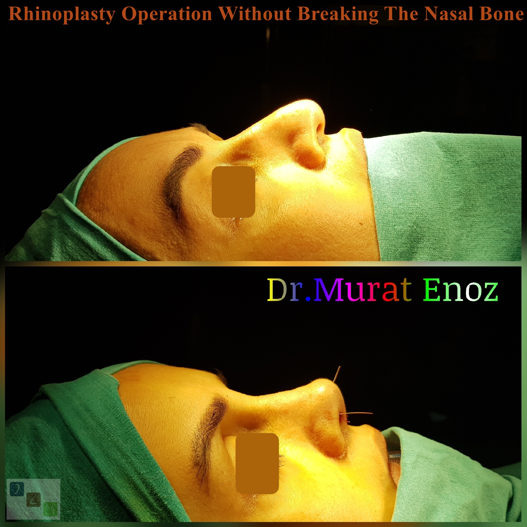 Rhinoplasty Operation Without Breaking The Nasal Bone