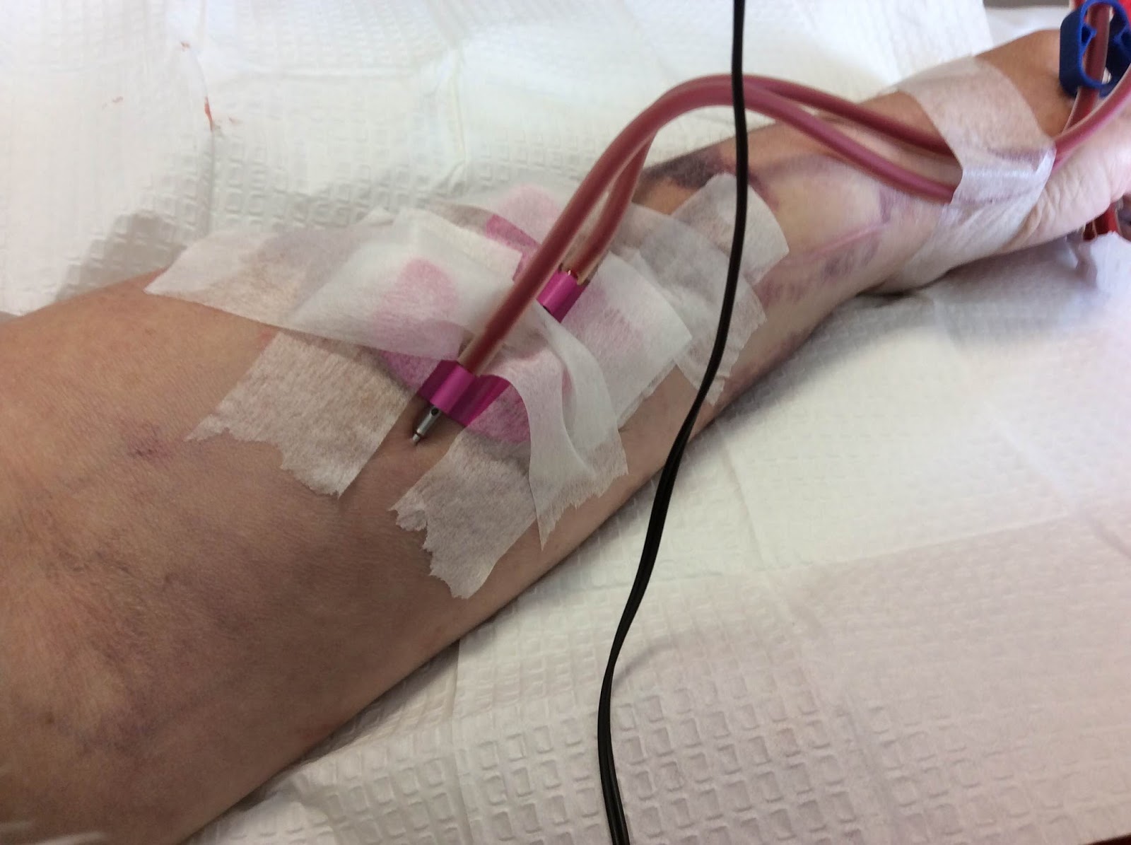 The sharp end of the needle Strictly Come Dialysis