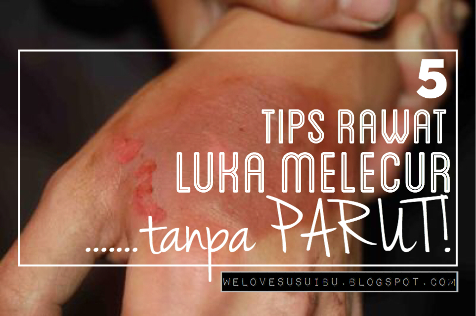 5 Tips Rawat Luka Melecur Cepat Sembuh Tanpa Parut Jelas Hadiah