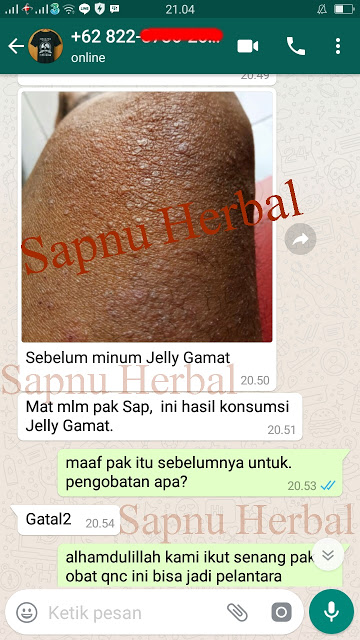 Cara Mengobati Bentol Bernanah Di Tangan Dan Kaki Secara Alami Terbukti Ampuh - Testimoni QnC Jelly Gamat Cara Mengobati Bentol Bernanah Di Tangan Dan Kaki Secara Alami Terbukti Ampuh - Testimoni QnC Jelly Gamat