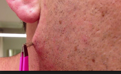 Acne In Hair >> Ingrown Hair Acne Acne In Hair >> Ingrown Hair Acne