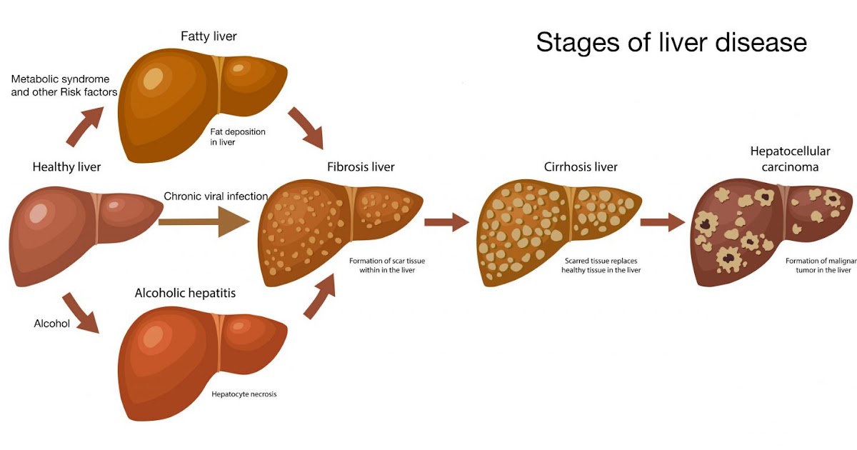 Cirrhosis of liver- By Dr Vishal Khurana (Senior Gastroenterologist ...