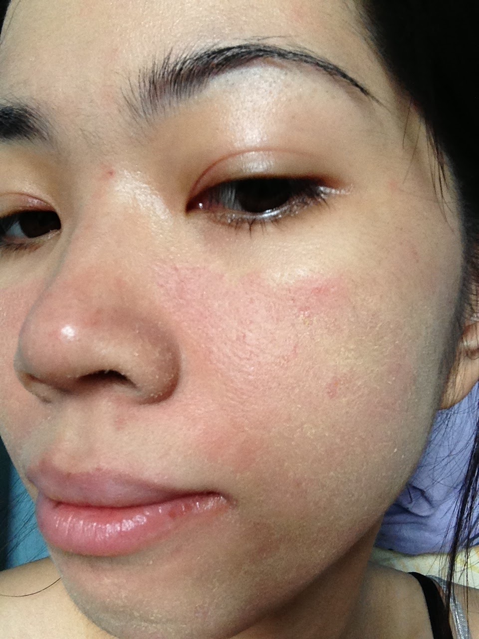 i have oily skin but my face is peeling