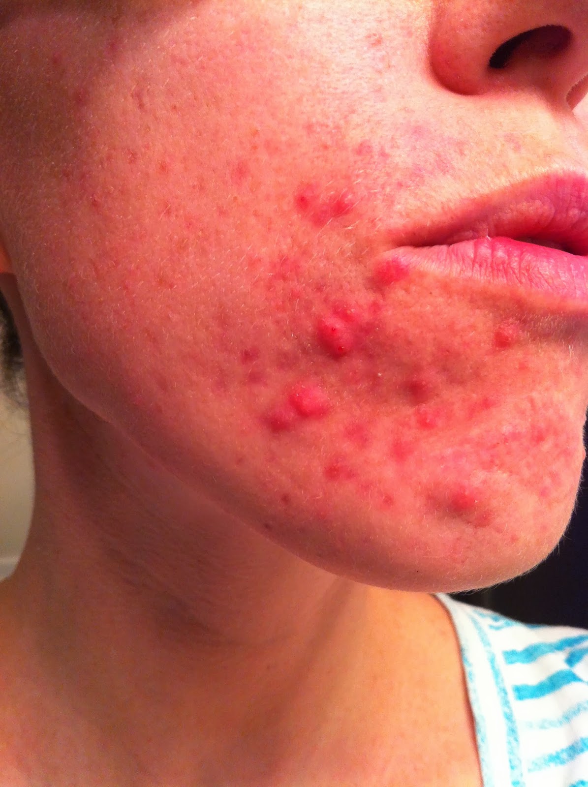 baby acne around mouth #10
