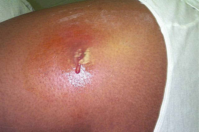 Buruli ulcer