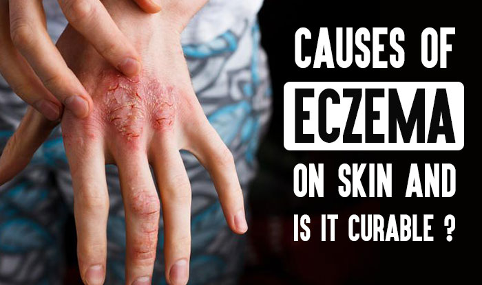 Causes of Eczema on Skin and How to Take Care of it