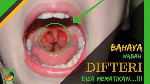 Gejala Difteri: Ciri-ciri, Penyebab & Cara Mengobatinya Gejala Difteri: Ciri-ciri, Penyebab & Cara Mengobatinya