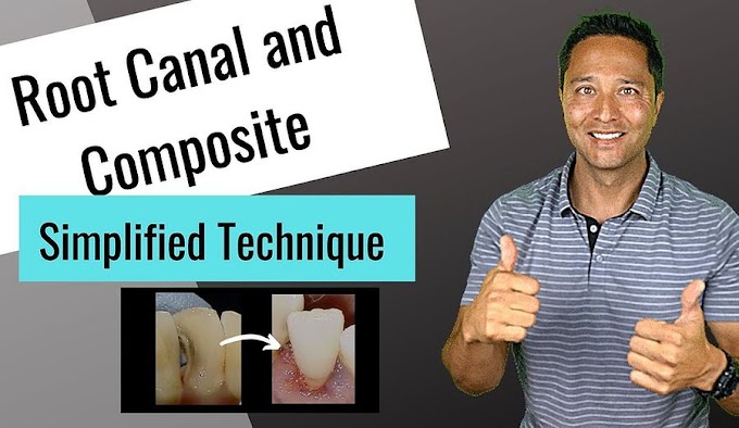 ENDODONTICS: Dental Filling Cavity and Root Canal Procedure Completed Same Appointment