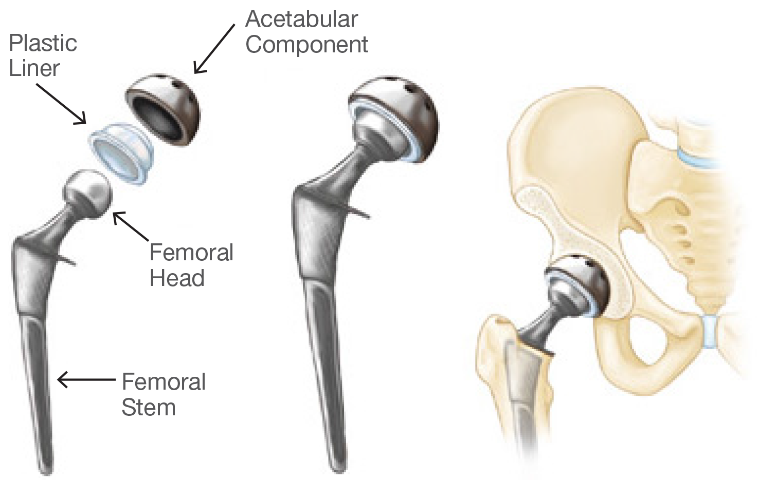 Hobart Orthopaedics Avail The Best Anterior Hip Replacement In Hobart