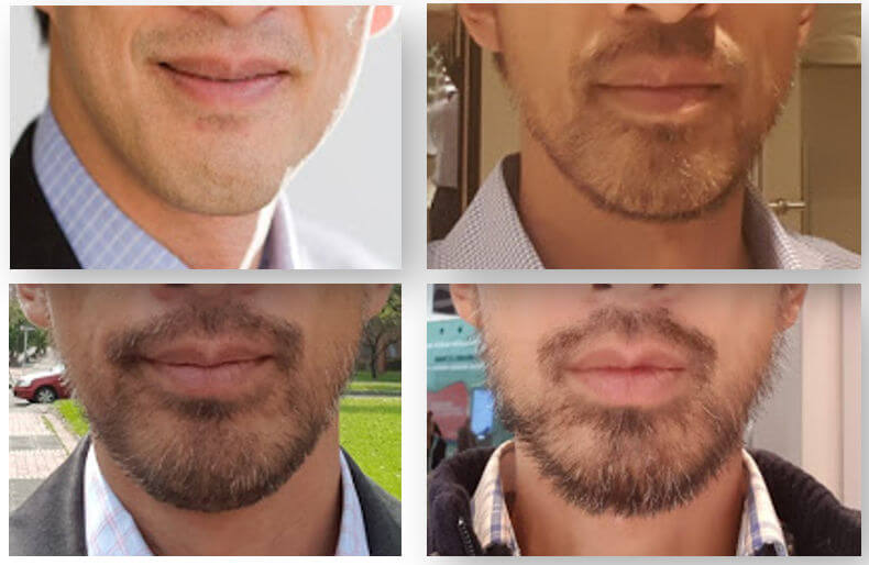 Featured image of post Minoxidil Beard Before And After Over the last several years minoxidil has played a tremendous role in improving men s beards