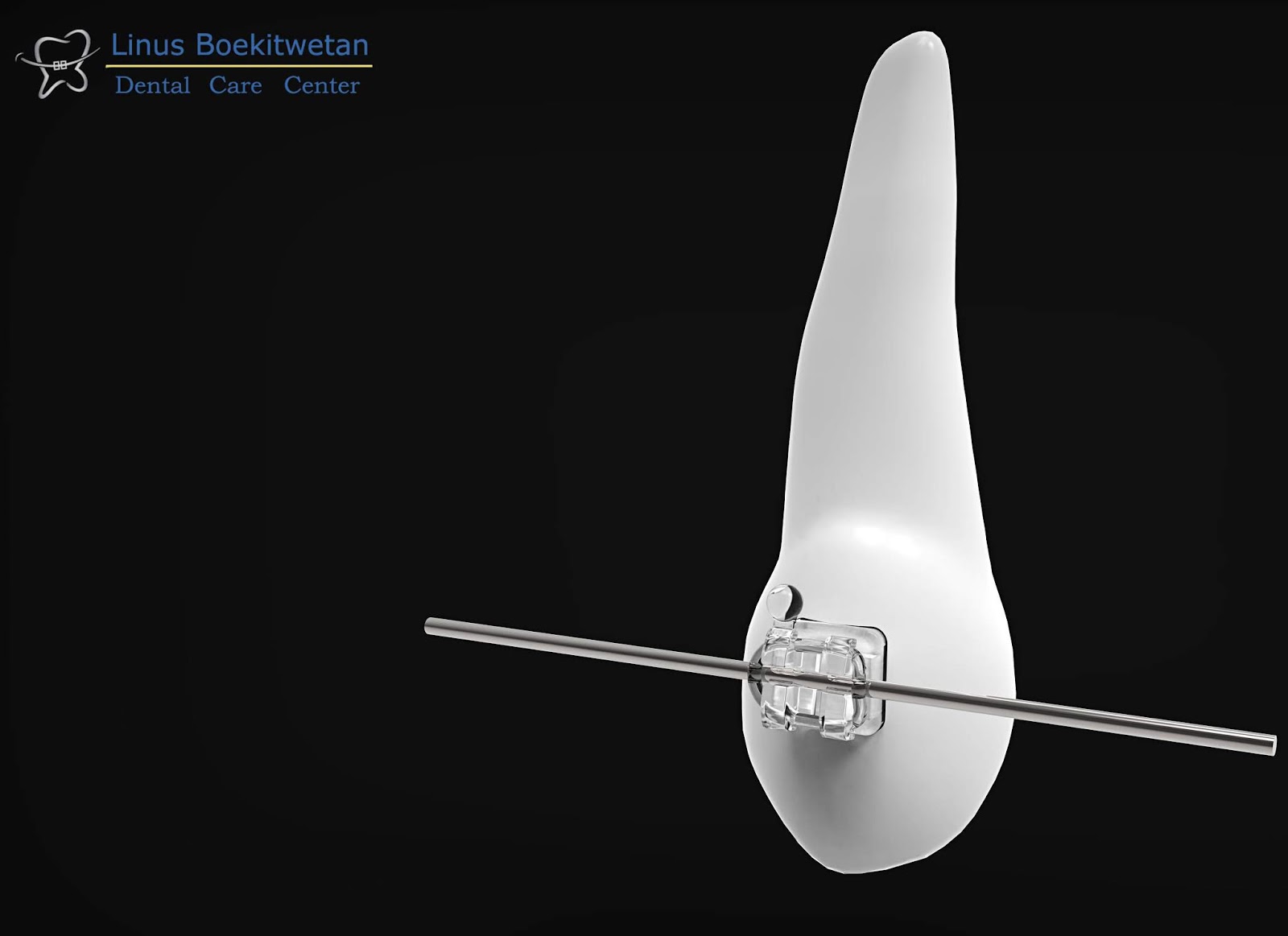 Linus Boekitwetan Dental Care Official Braces Materials