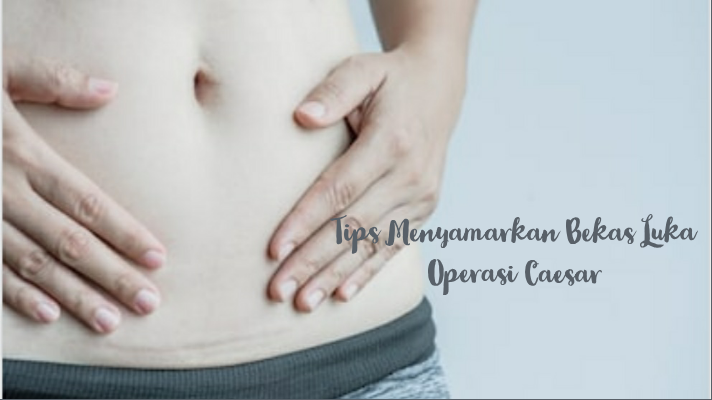 Tips Menyamarkan Bekas Luka Operasi Caesar - Inuel's Personal Blog