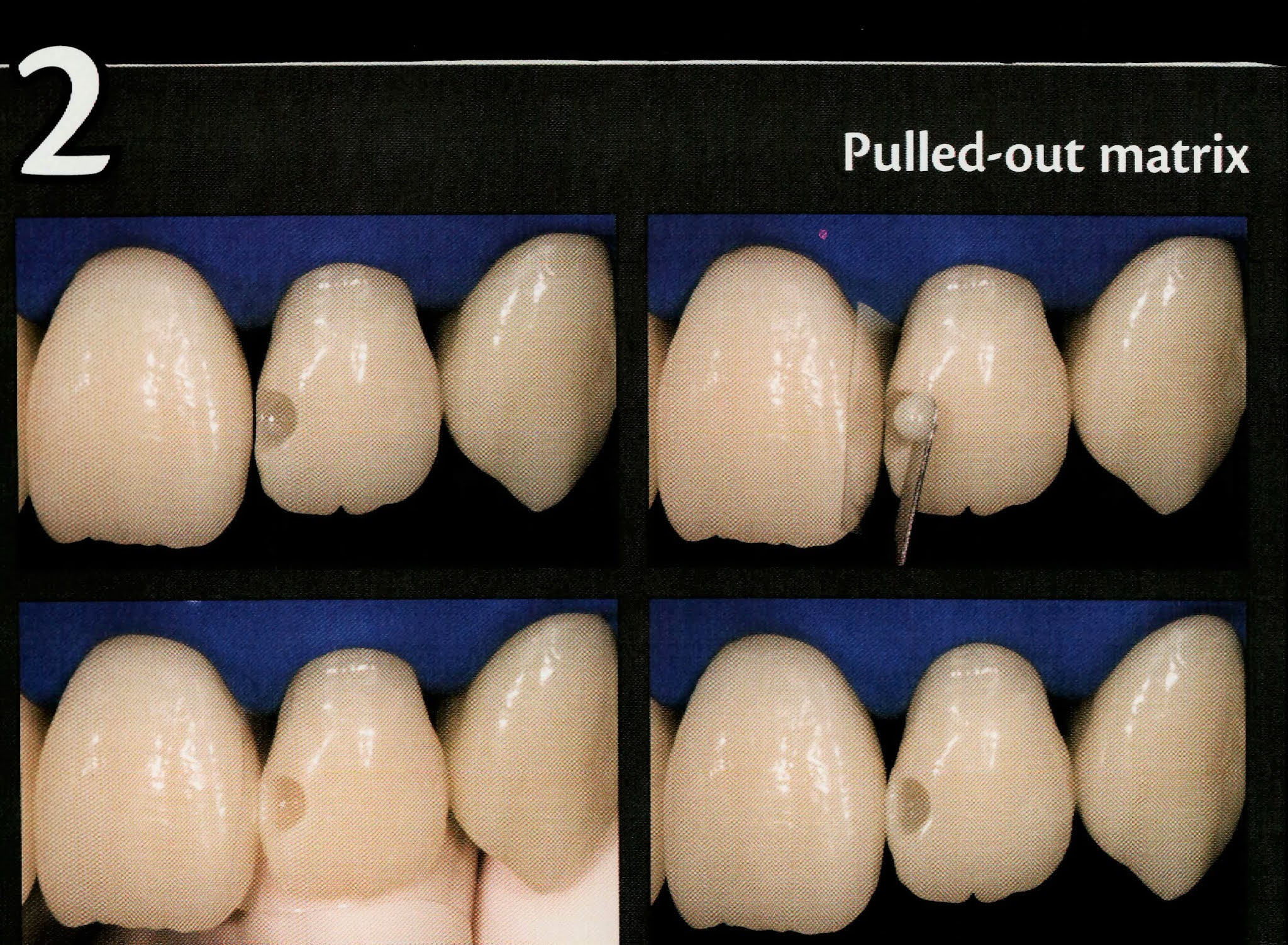 Class III Composite restoration " Labial access " Dental Esthetics