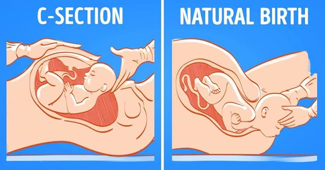 Cesarean or Normal Birth