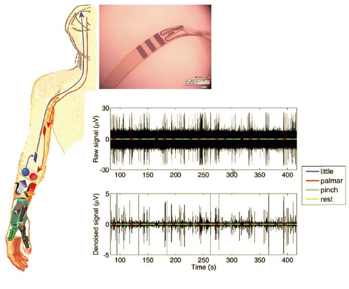 Biomedical Engineering Inventions : Bionic hand that can sense and feel