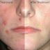 Adult Acne Solutions and Home Remedies