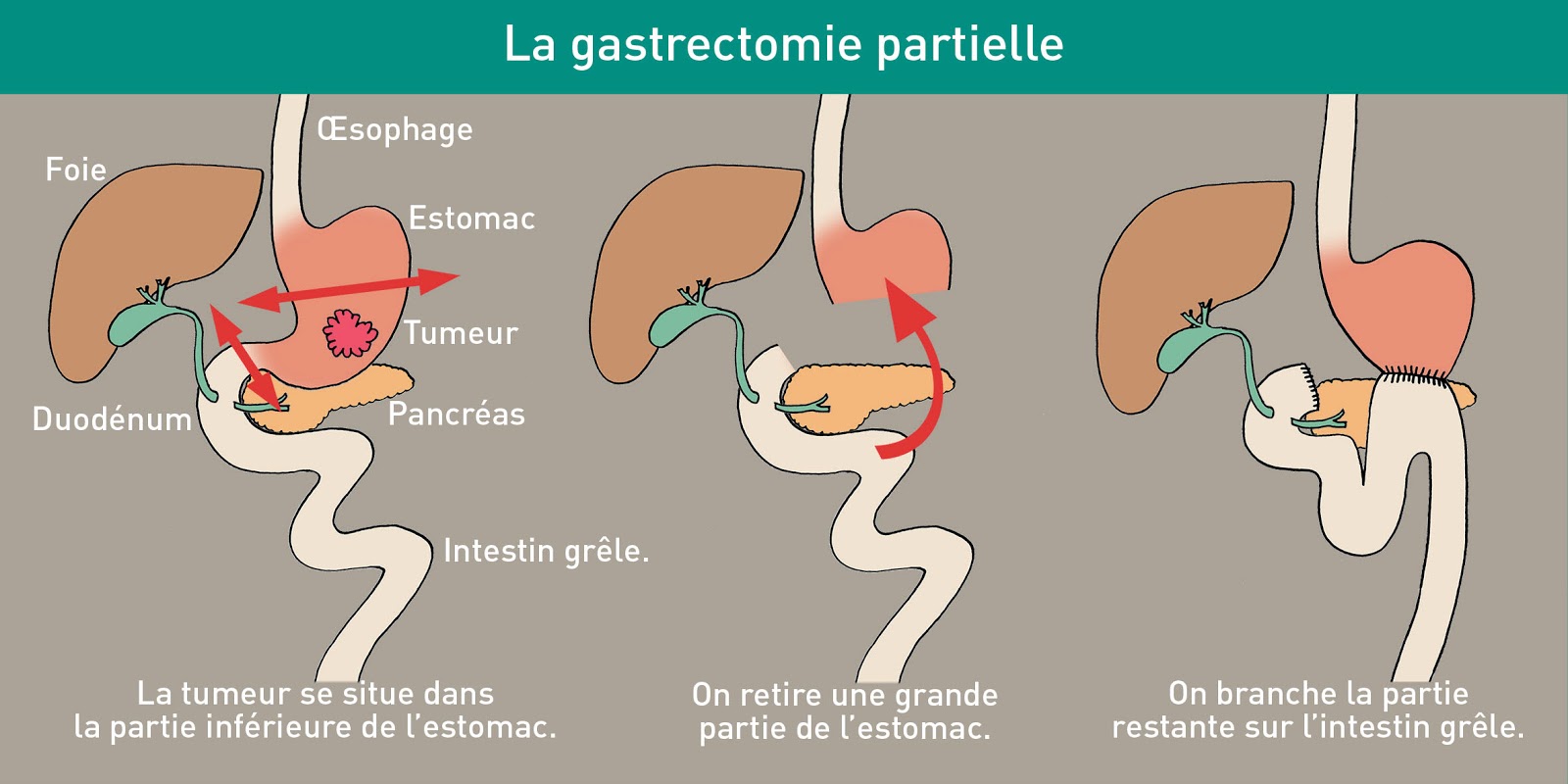 CHIRURGIE DIGESTIVE ET HEPATOBILIAIRE Cancer de l'estomac
