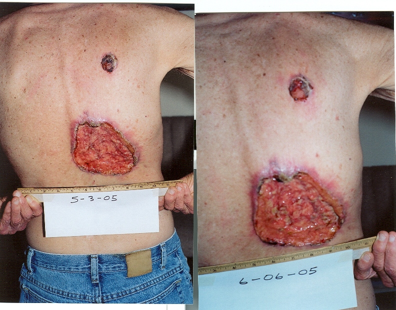 Colon Cancer Prognosis For Stage 4 Colon Cancer