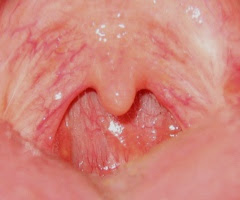 https://commons.wikimedia.org/wiki/File:Uvula_without_tonsils.jpg