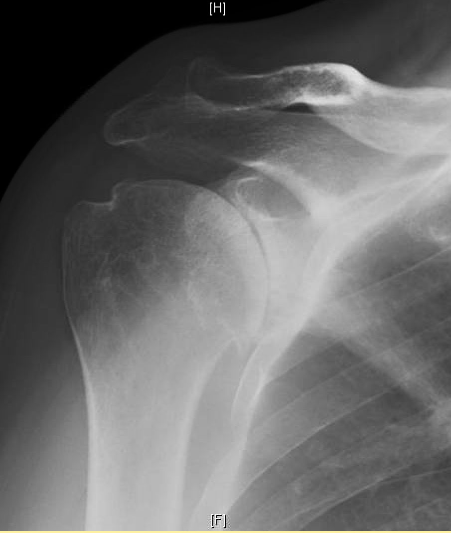 Shoulder Arthritis / Rotator Cuff Tears causes of shoulder pain Ream