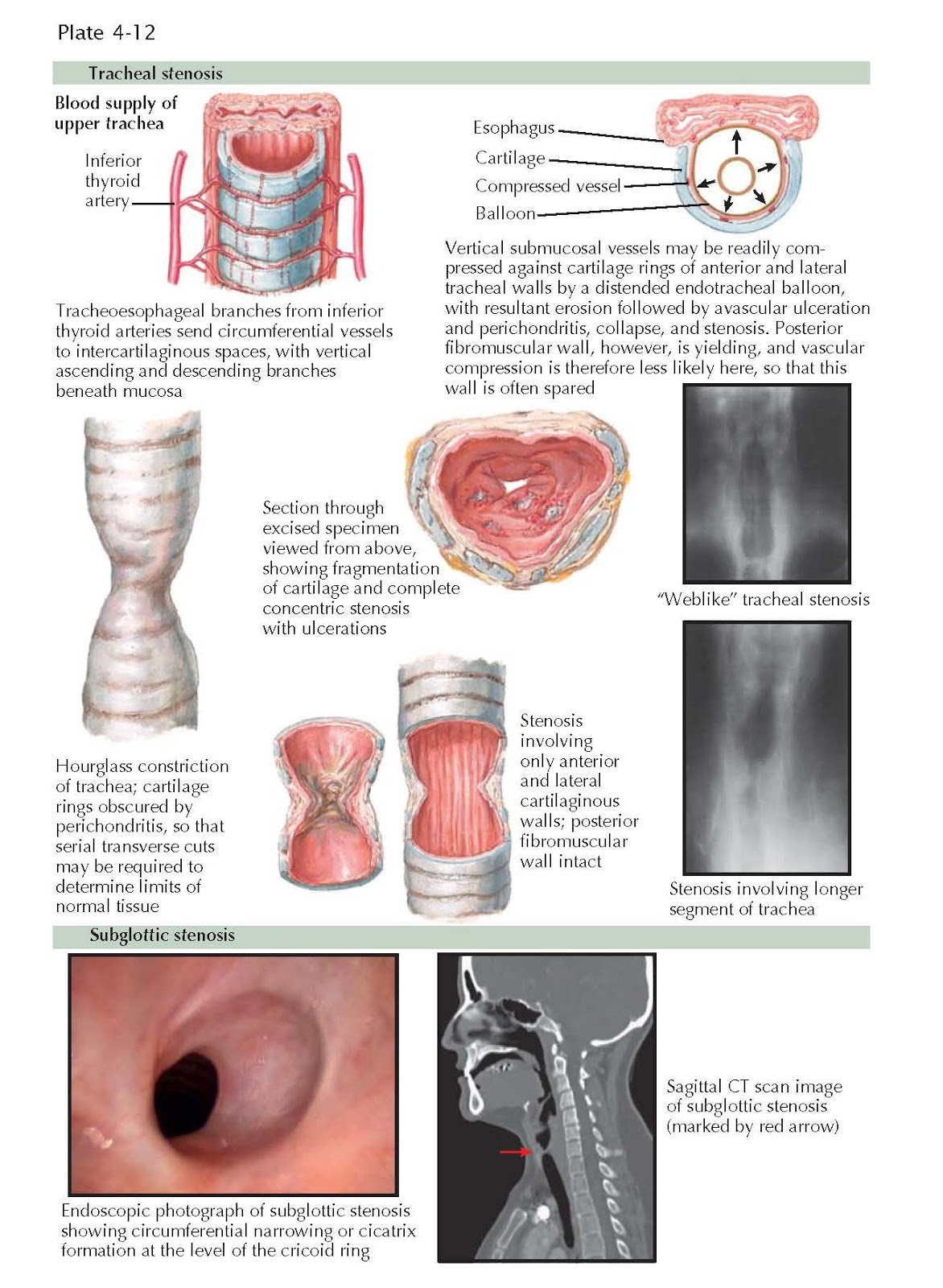 LARYNGEAL AND TRACHEAL STENOSIS pediagenosis