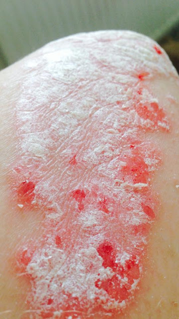 Psoriasis on my elbow and arm