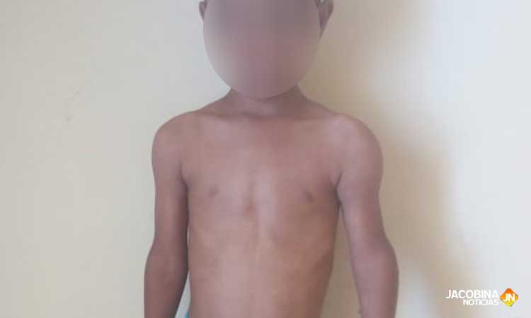 Jacobina: Pais desempregados pedem ajuda para filho com doença grave nos ossos