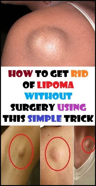 How To Get Rid Of Lipoma Without Surgery Using This Simple Trick
