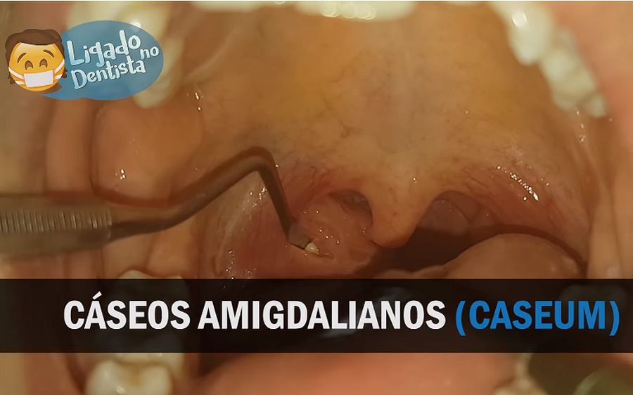 Cáseos amigdaliano (caseum): o que é, sintomas, causas e